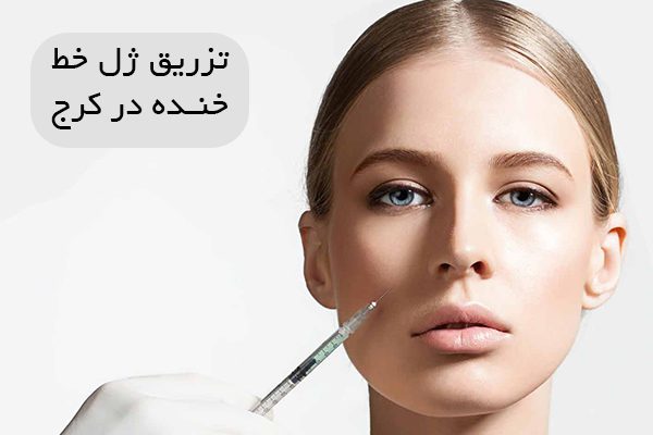 تزریق ژل خط خنده در کرج