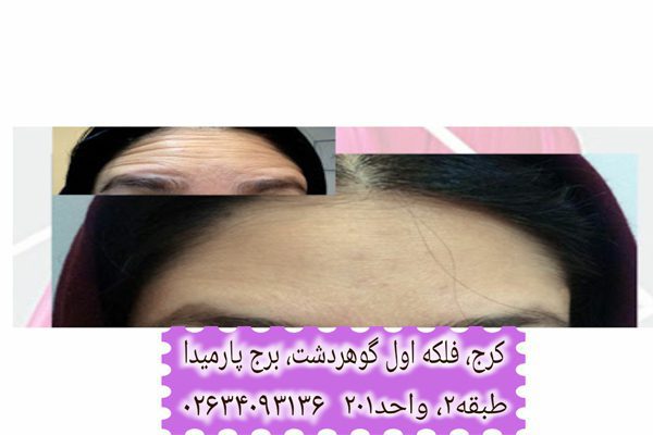 سابسیژن پیشانی کرج