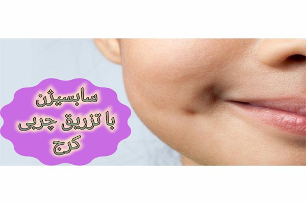 سابسیژن با تزریق چربی کرج