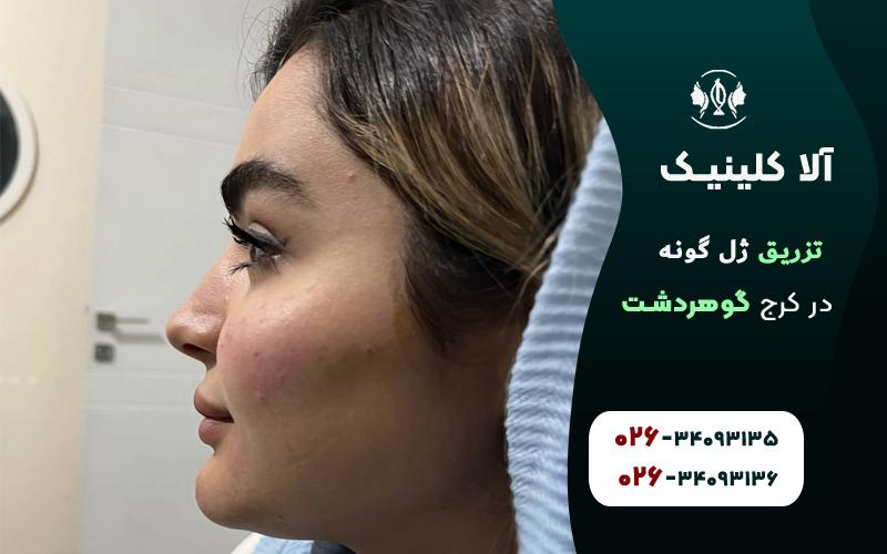 تزریق ژل در گوهردشت کرج