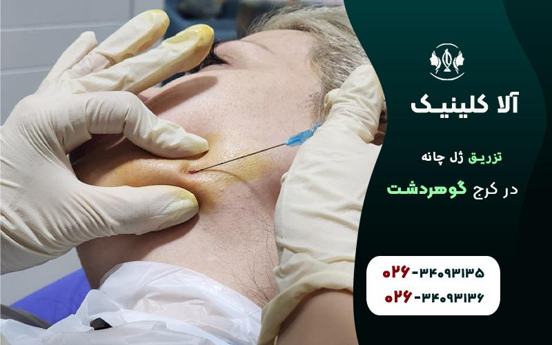 تزریق ژل چانه در کلینیک آلا