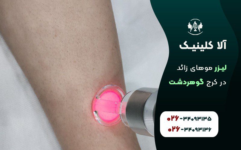 روشن کردن بیکینی با لیزر موهای زائد