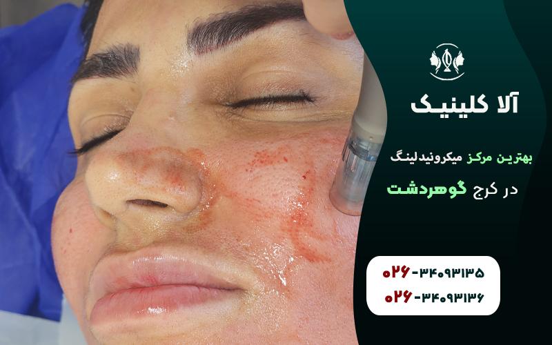 بهترین مرکز میکرونیدلینگ در کرج