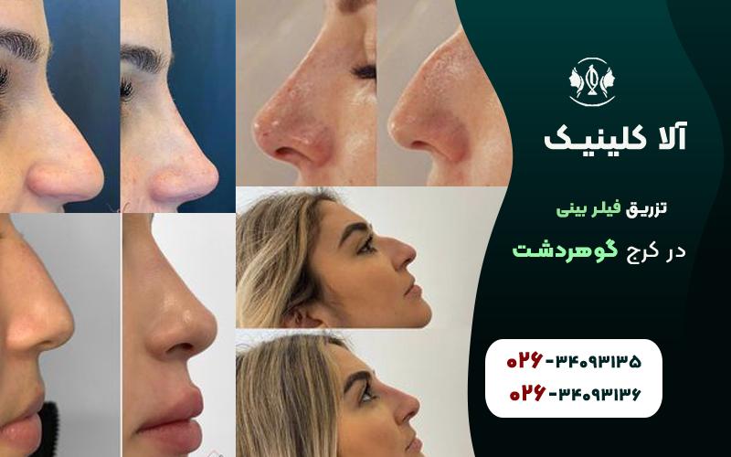 تزریق فیلر بینی در گوهردشت کرج