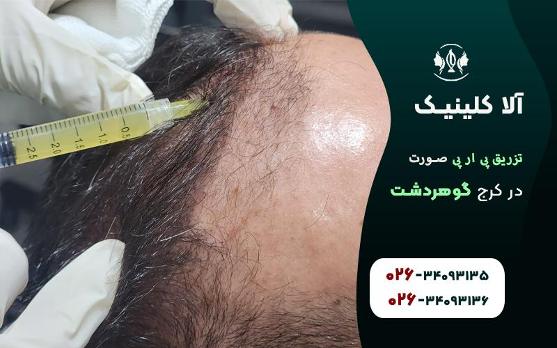 تزریق پی ار پی صورت در کرج