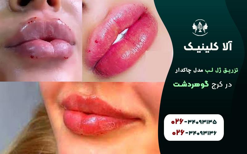 تزریق ژل لب مدل چاکدار چگونه است