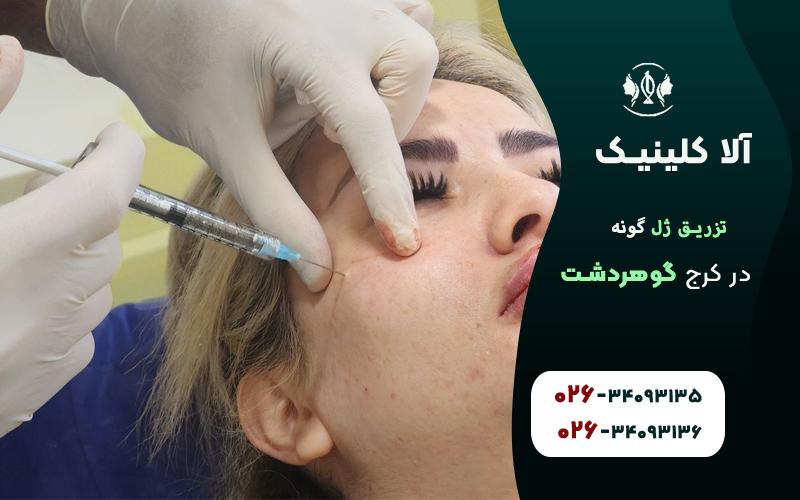 تزریق ژل گونه در کرج