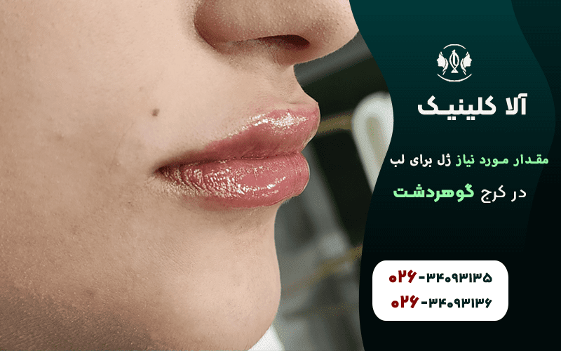 مقدار موردنیاز برای تزریق ژل لب