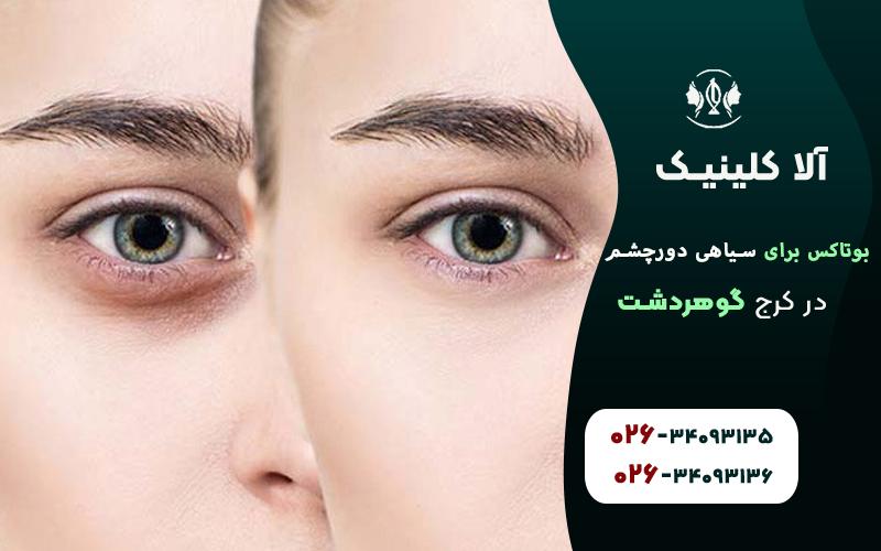 بوتاکس برای سیاهی دور چشم