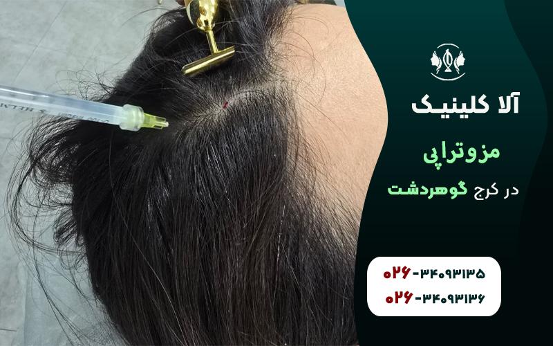 مزوتراپی کرج