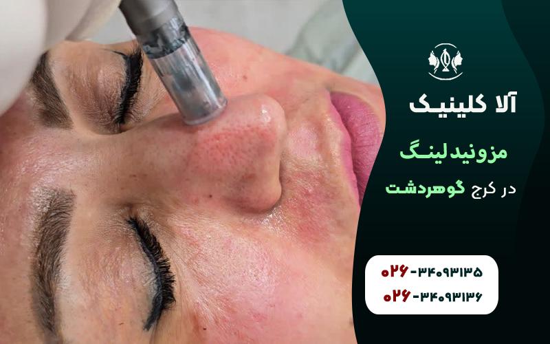 مزو نیدلینگ کرج