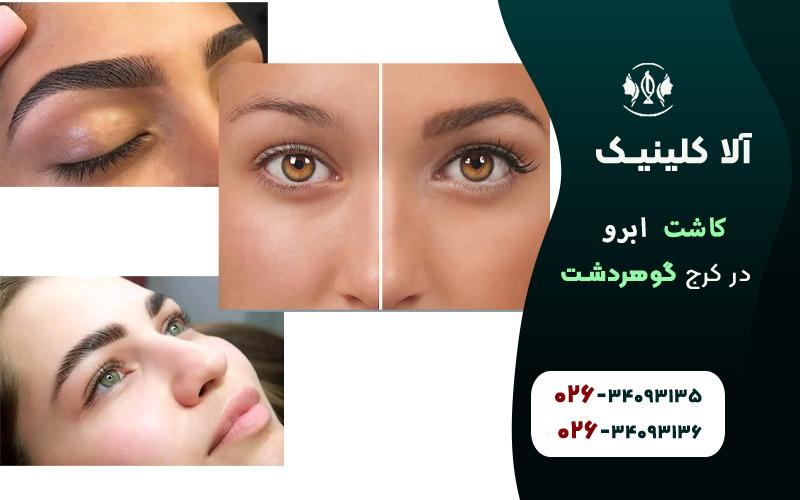 کاشت ابرو کرج