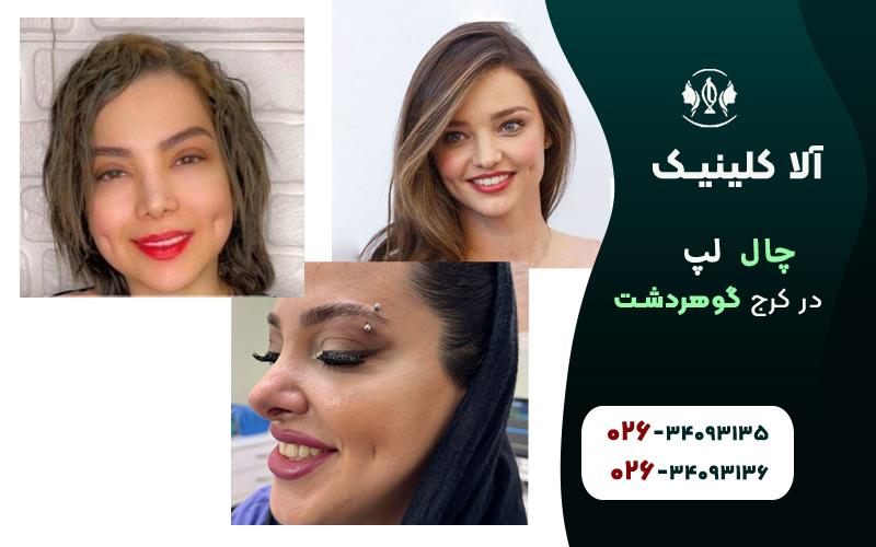 چال لپ در کرج