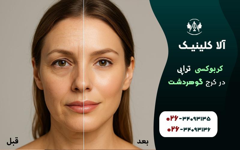 کربوکسیتراپی کرج