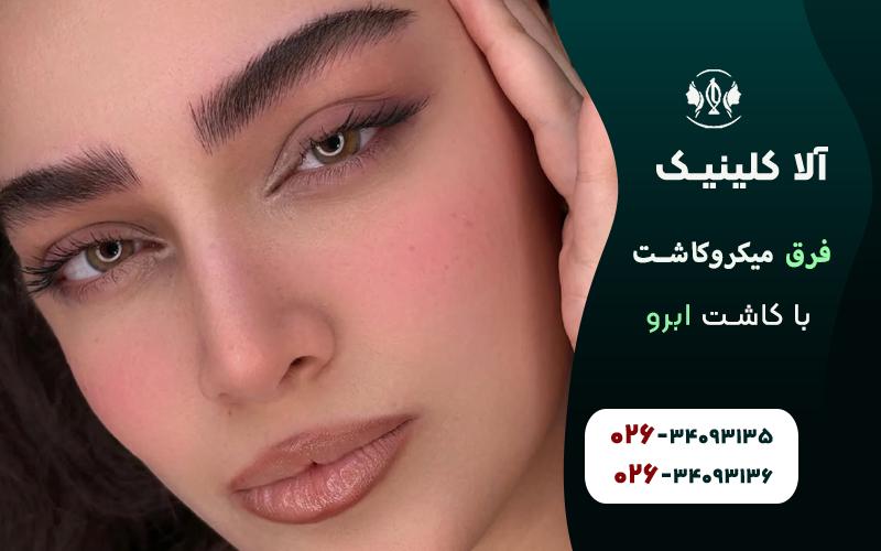 فرق میکرو کاشت با کاشت ابرو