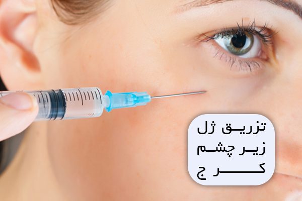 تزریق ژل زیر چشم کرج