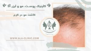 کاشت مو در کرج