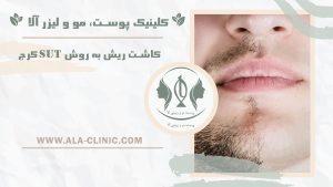 کاشت ریش به روش sut کرج