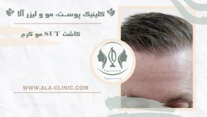 کاشت SUT مو کرج