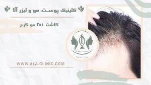 کاشت fut مو کرج