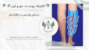 درمان واریس در گلشهر