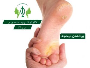 برداشتن میخچه در کرج