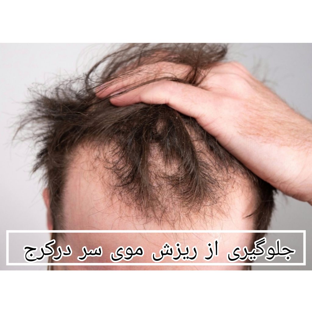 جلوگیری از ریزش موی سر در کرج