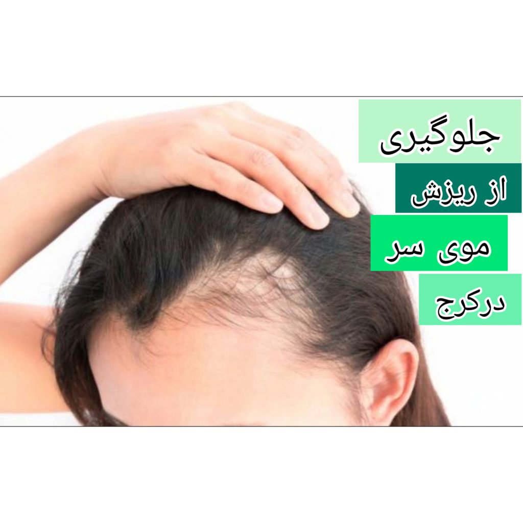 جلوگیری از ریزش موی سر در کرج