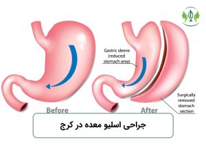 جراحی اسلیو معده در کرج