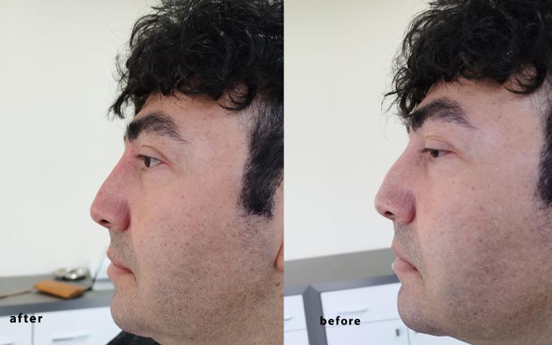 تصوری قبل و بعد از تزریق فیلر بینی در کرج