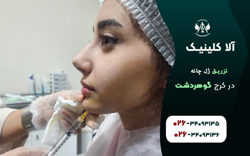 تزریق ژل چانه در گوهردشت کرج