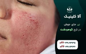 لیزر جای جوش در کرج