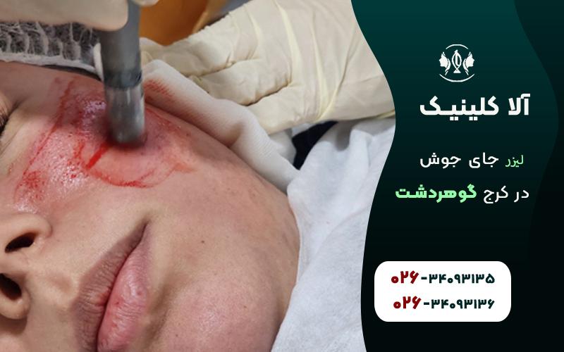 لیزر جای جوش در کلینیک آلا