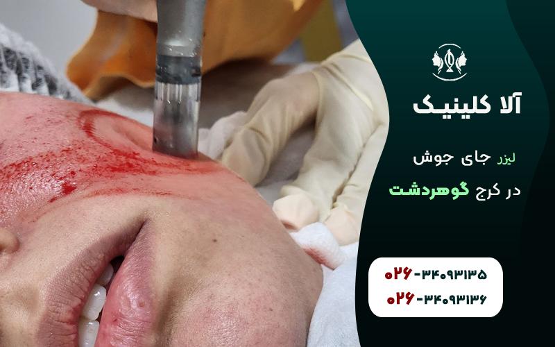 لیزر جای جوش در گوهردشت