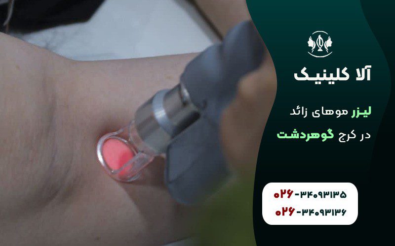 لیزر موهای زائد زیر بغل در کرج