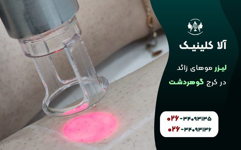 لیزر موهای زائد بیکینی در کلینیک آلا