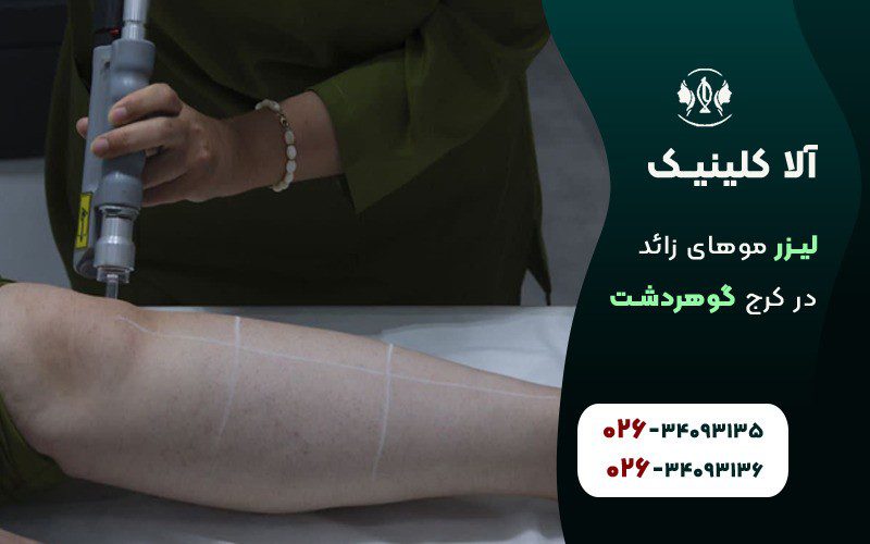لیزر موهای زائد در کلینیک آلا