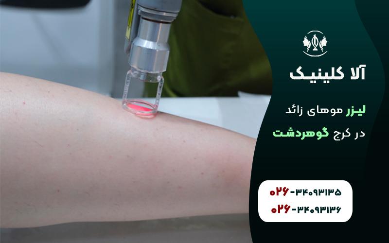 لیزر موهای زائد بیکینی در گوهردشت