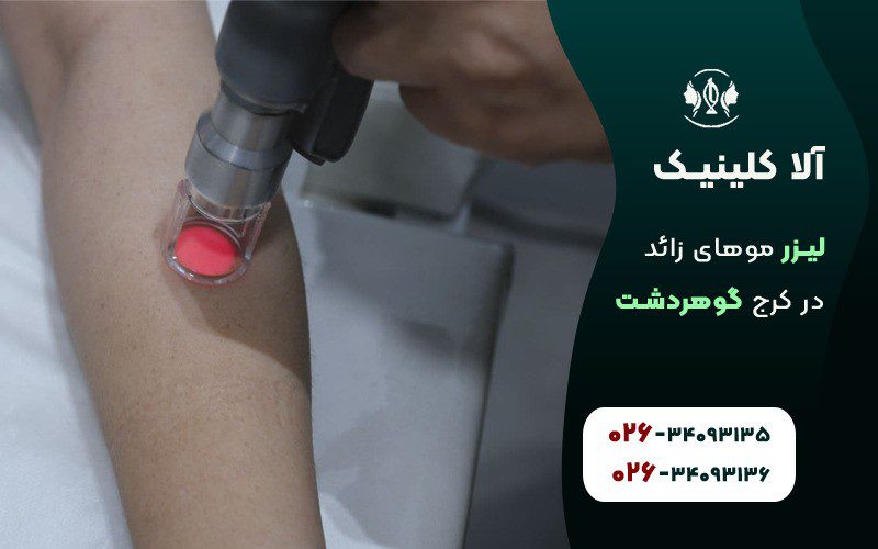 لیزر موهای زائد بدن در گوهردشت