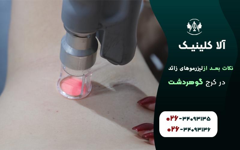 10نکته حیاتی برای بعد از لیزر موهای زائد