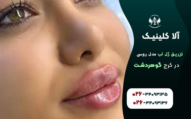 تصویر تزریق ژل لب مدل روسی