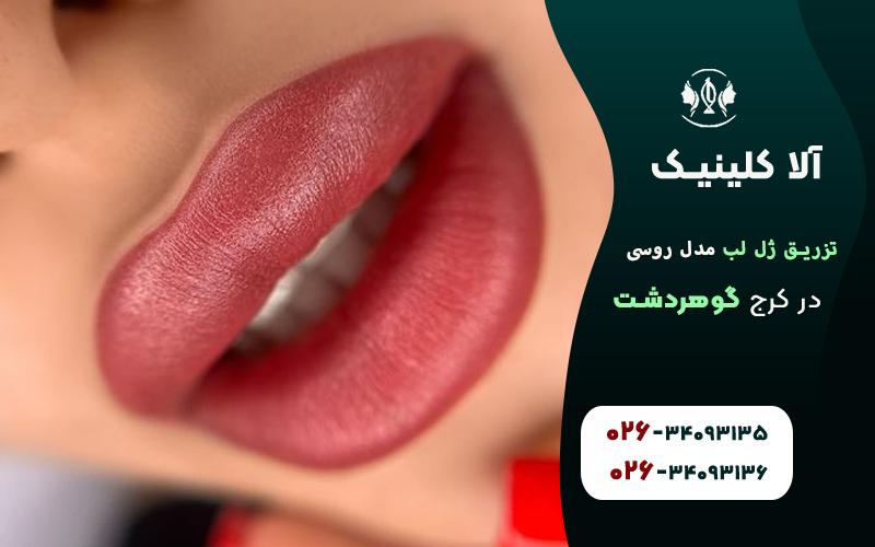 تزریق ژل لب مدل روسی