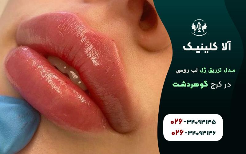 تزریق ژل لب مدل روسی