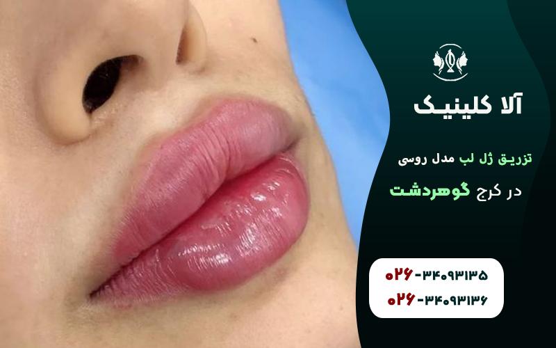 تزریق ژل لب مدل روسی