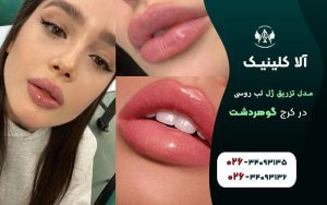 تصاویر مدل تزریق ژل لب روسی