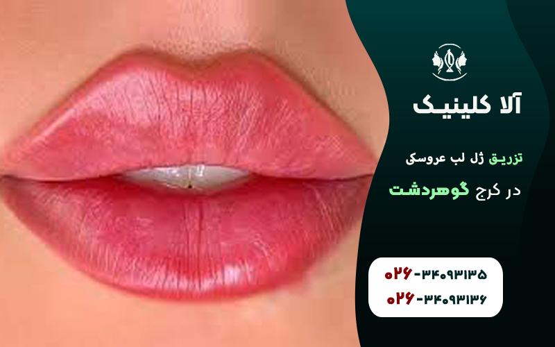 تزریق ژل لب مدل عروسکی