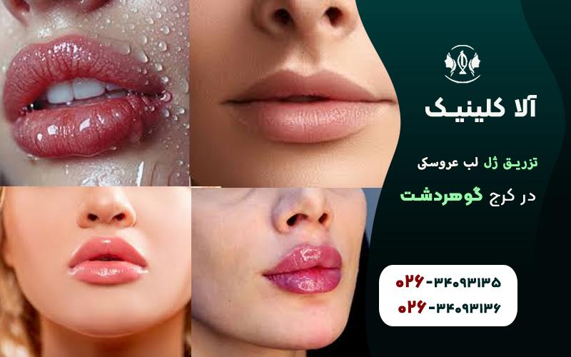 تزریق ژل لب مدل عروسکی کلینیک آلا