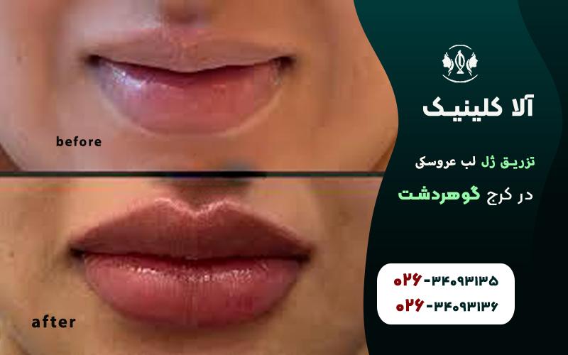 تزریق ژل لب مدل عروسکی