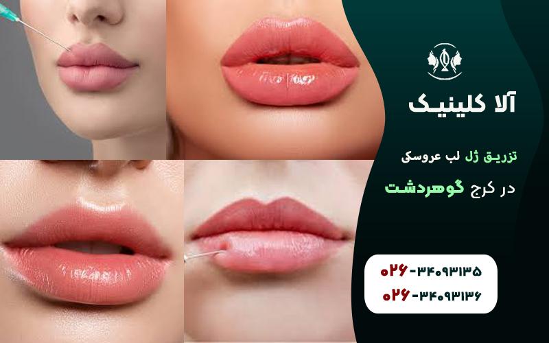 تزریق ژل لب مدل عروسکی