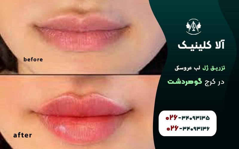 تزریق ژل لب مدل عروسکی کرج